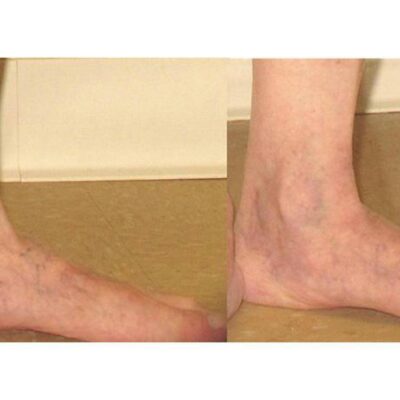Ankle Veins