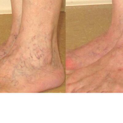 Ankle Veins