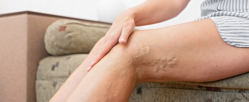 Varicose Veins, Sclerotherapy