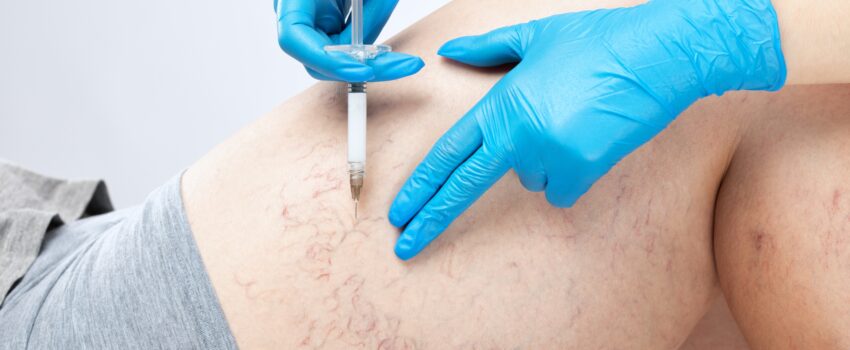 A doctor performs sclerotherapy on someone's unsightly leg veins