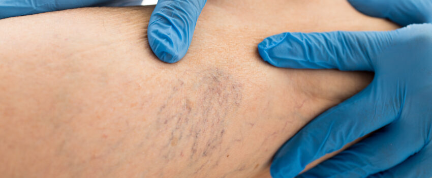 A doctor's hands hold a leg while the spider veins on the leg are centered in the image