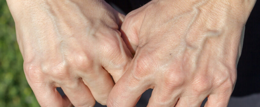 A woman’s hands are held out with prominent varicose veins sticking out on the back of them