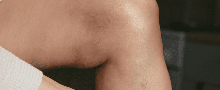 Spider veins on a woman's thigh