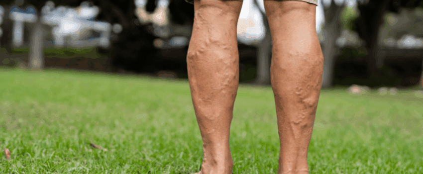 a man's legs standing in the grass with visible varicose veins
