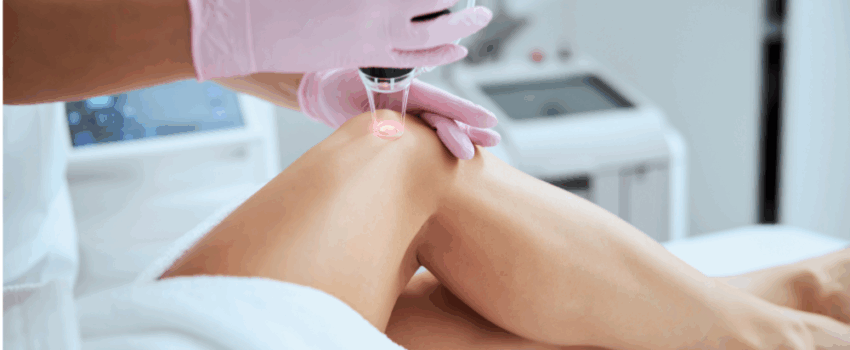 A patient receiving laser vein treatment on their leg