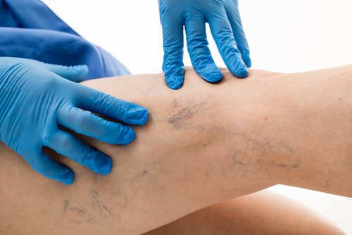 A leg with spider veins is being examined by a doctor with blue gloves.